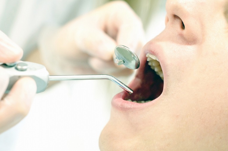 虫歯治療の方法