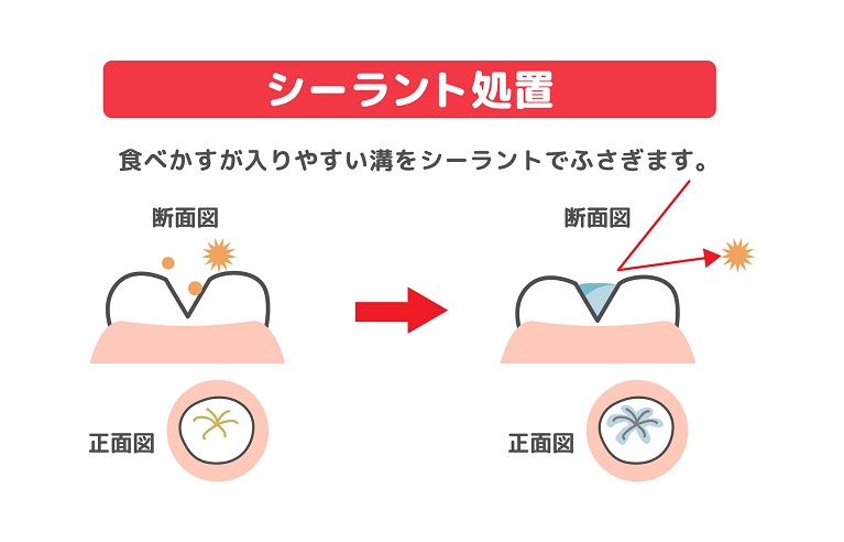 子供の予防歯科